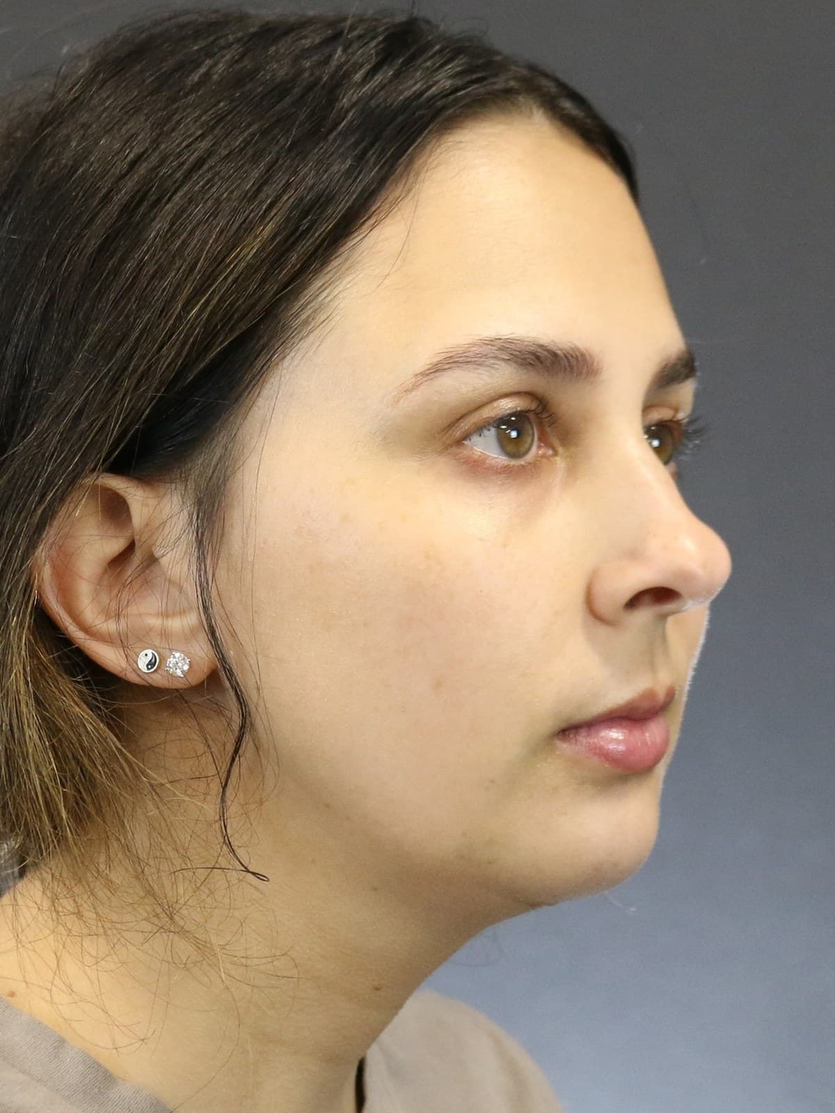 chin augmentation before and after