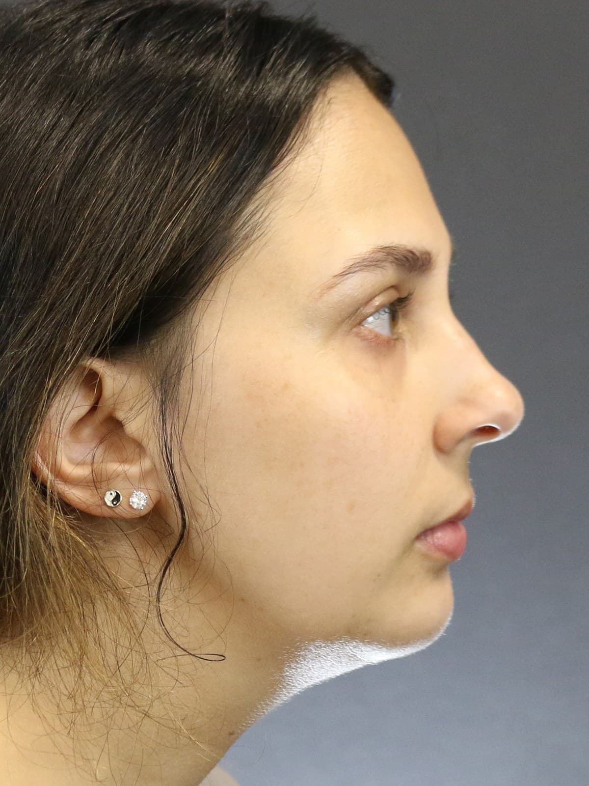 chin augmentation before and after