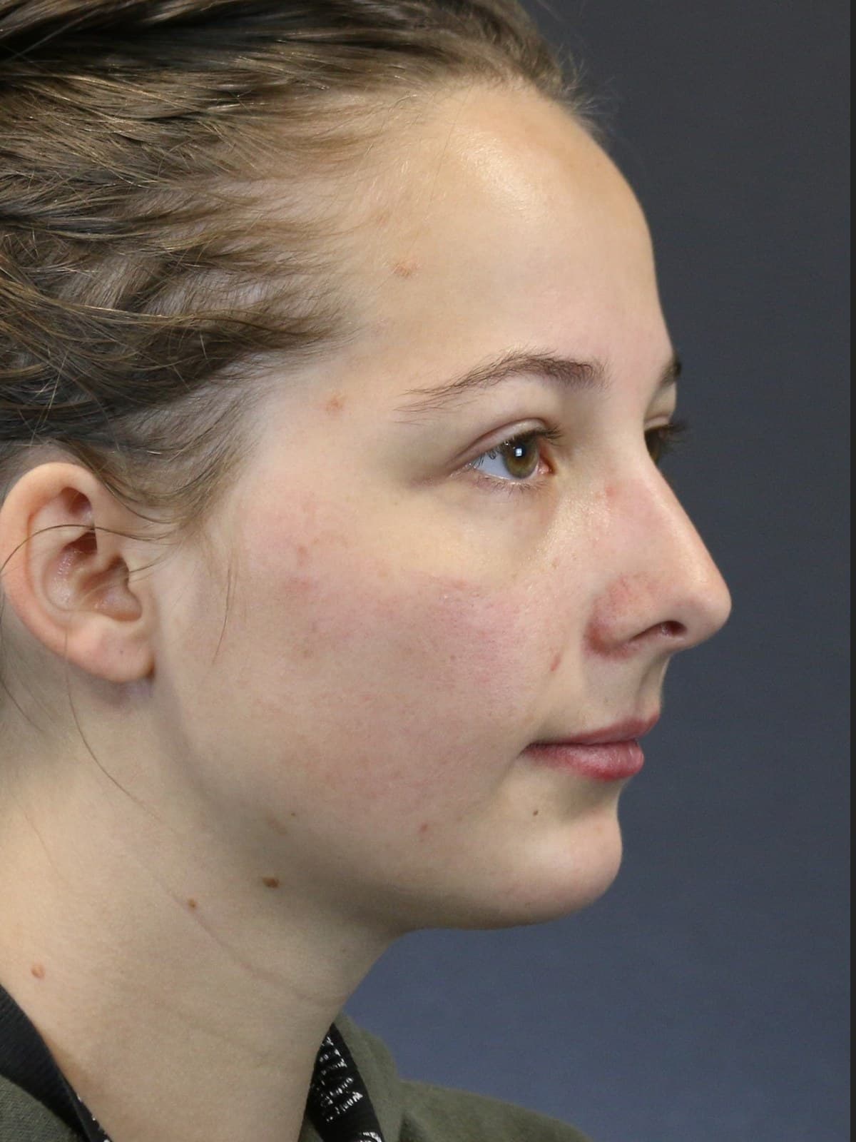 Chin Augmentation before and after