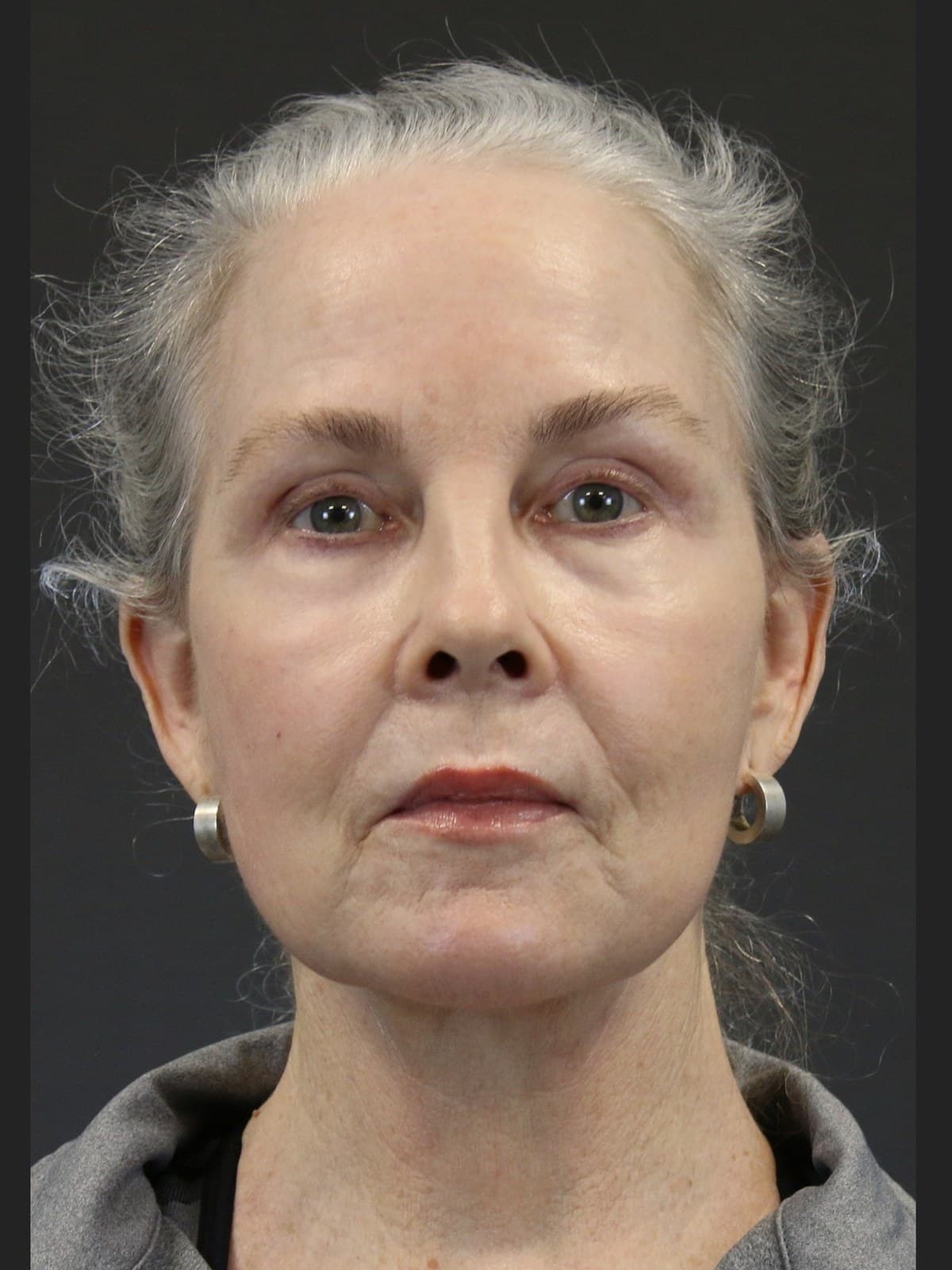 deep plane facelift before and after