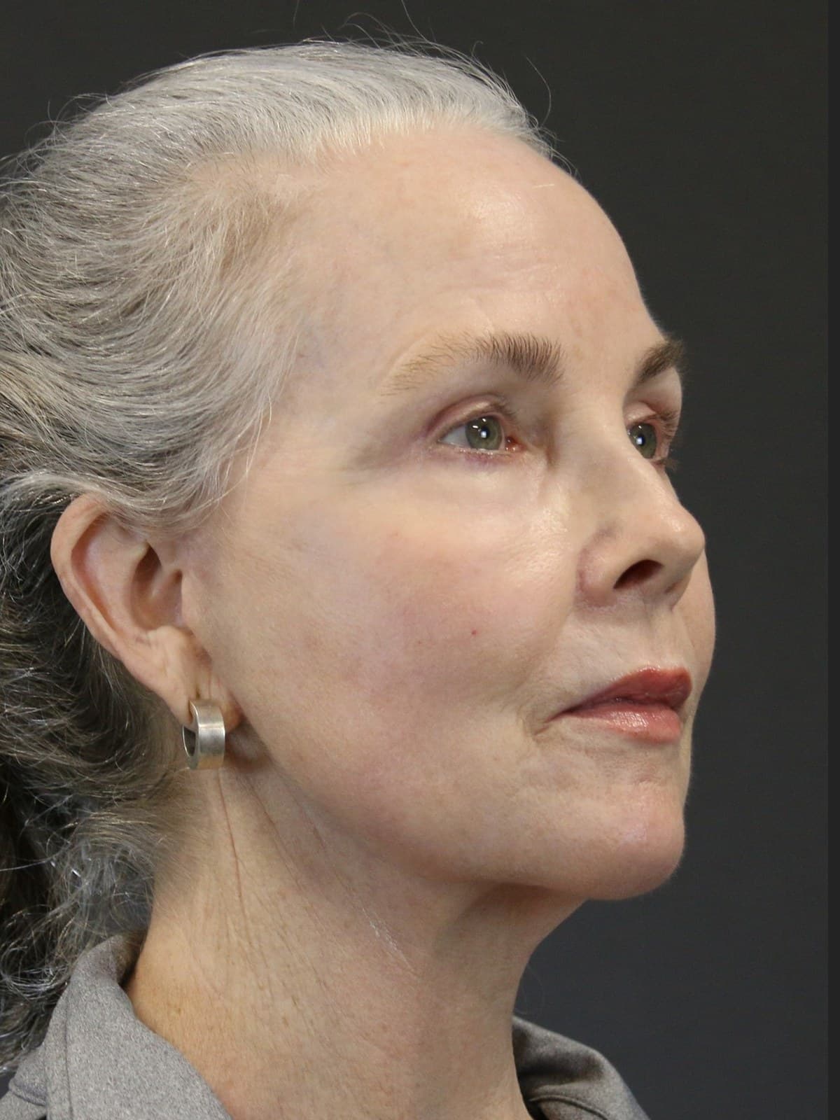 Deep Plane Facelift before and after