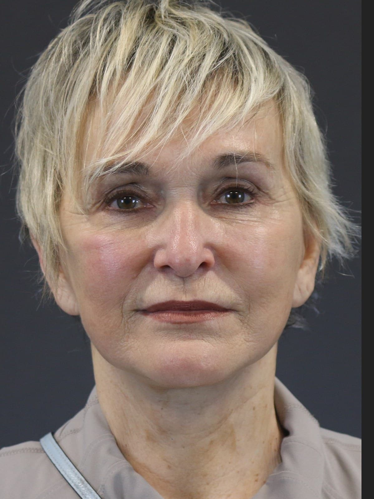 deep plane facelift before and after