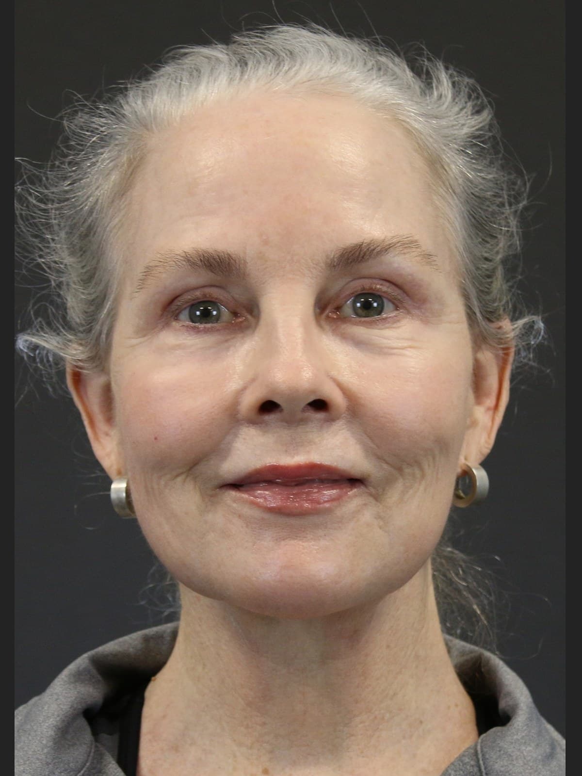 Eyelid Surgery before and after