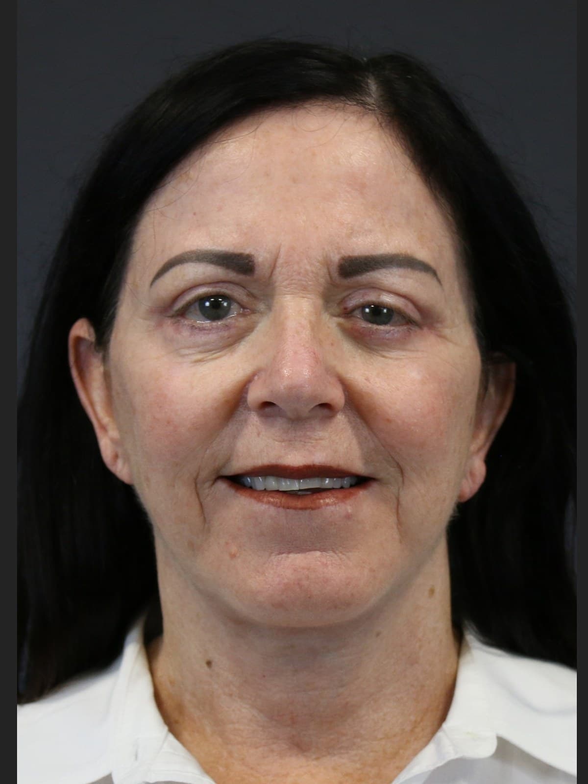 eyelid surgery before and after