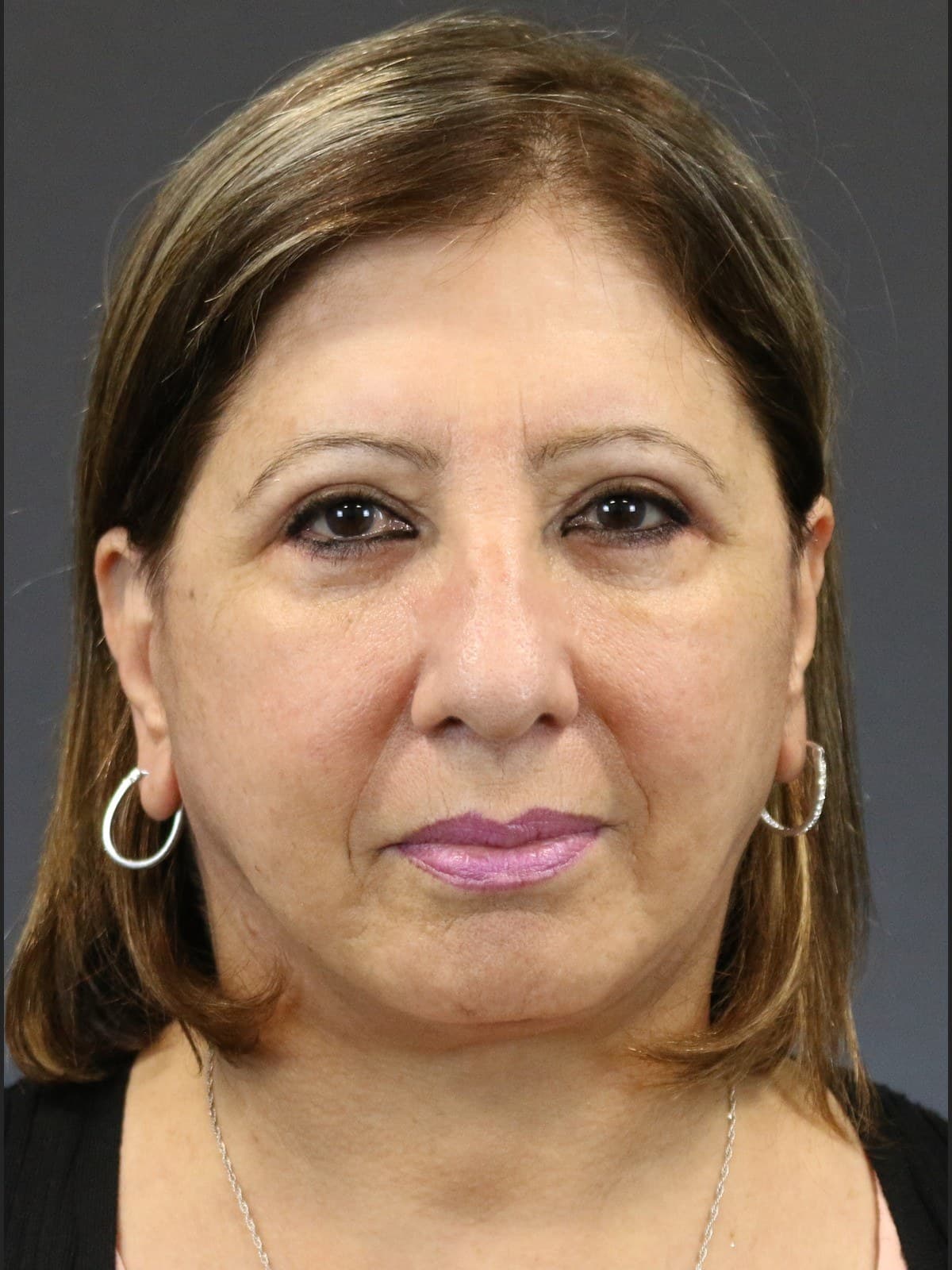eyelid surgery before and after
