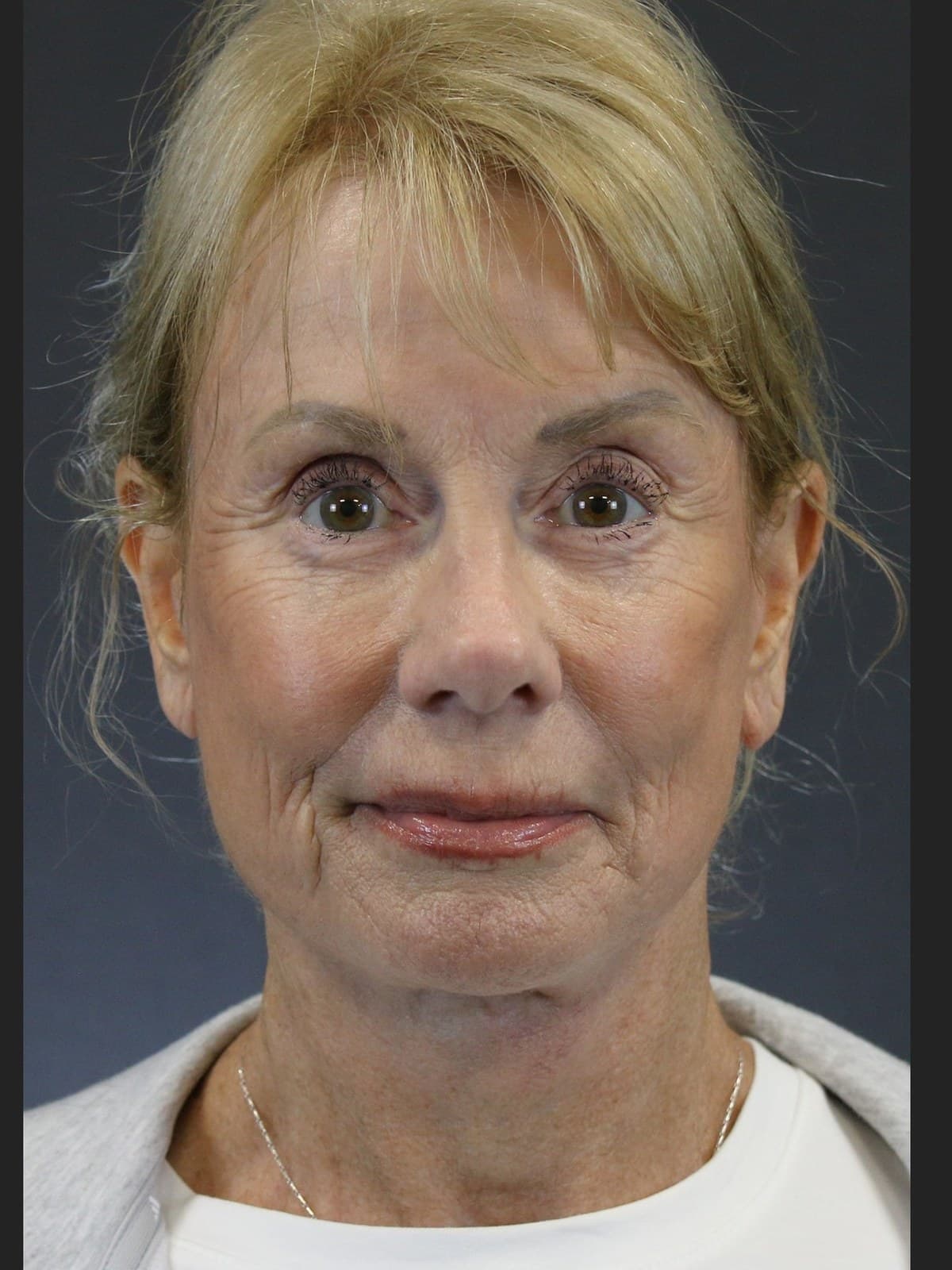 eyelid surgery before and after