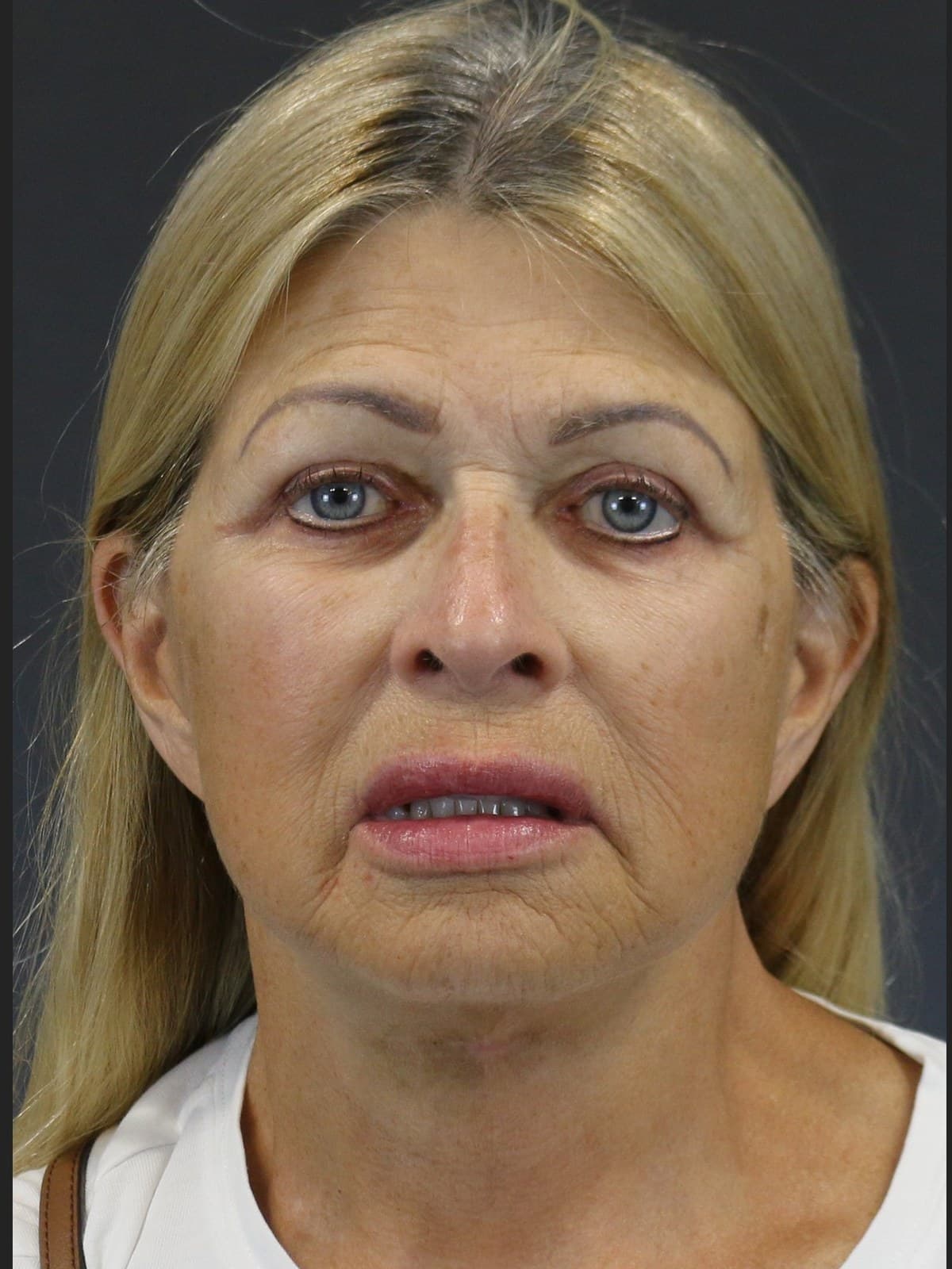 eyelid surgery before and after