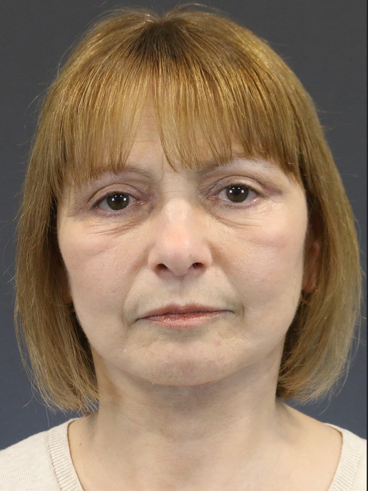 eyelid surgery before and after
