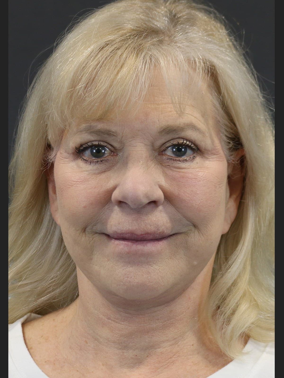 Eyelid Surgery before and after
