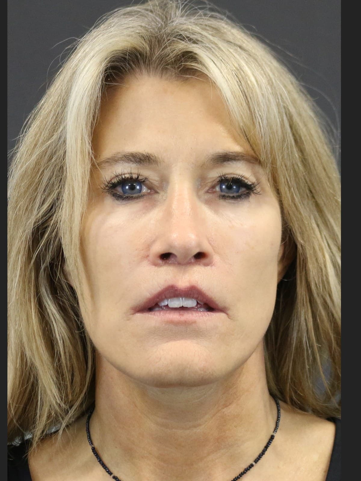 lip lift before and after