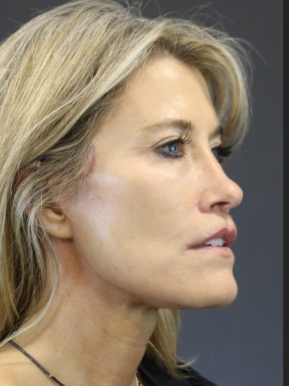 neck lift before and after