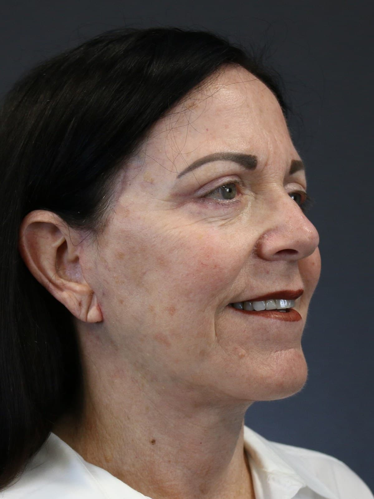 neck lift before and after