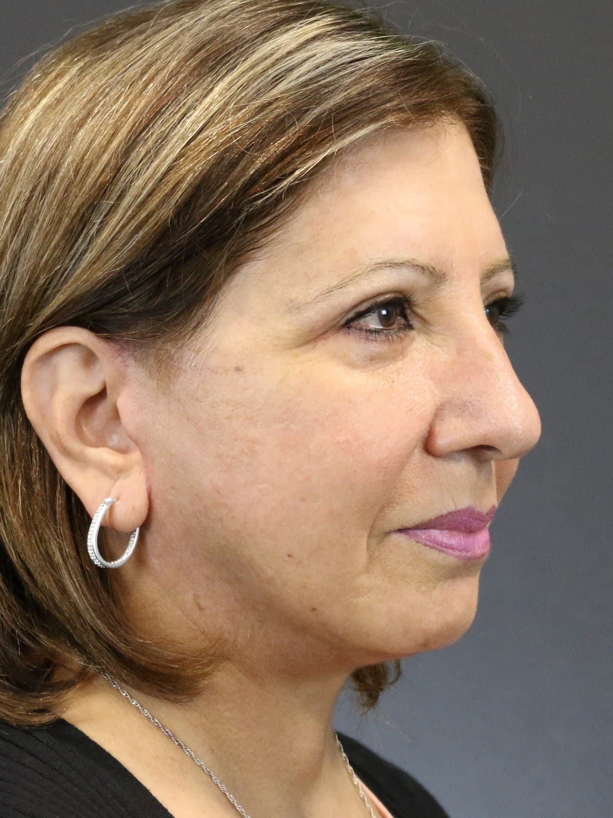 neck lift before and after