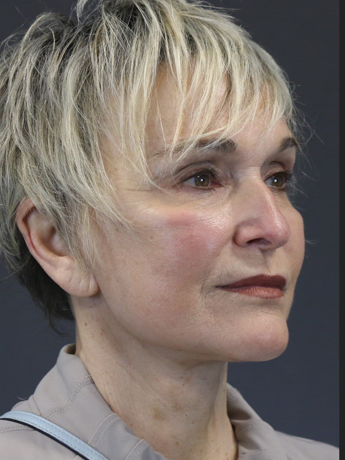 Neck Lift before and after