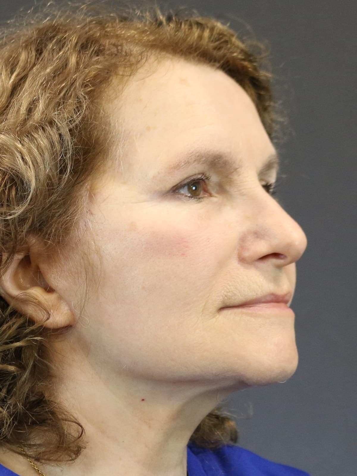 neck lift before and after