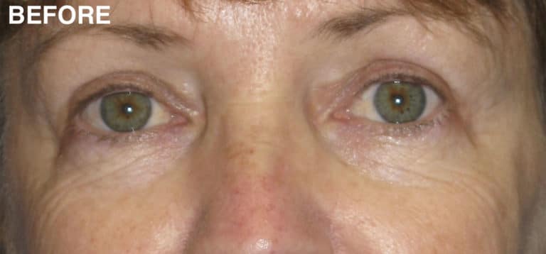Before Image: Blepharoplasty - front