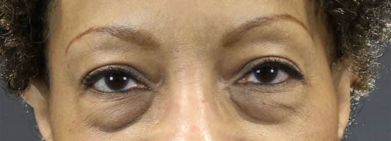 Before Image: Blepharoplasty - front