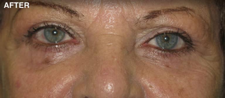 After Image: Blepharoplasty - front