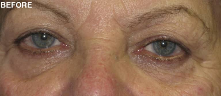 Before Image: Blepharoplasty - front