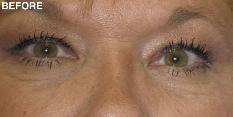 Before Image: Blepharoplasty - front