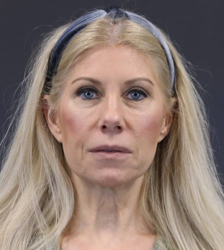 Before Image: Deep Plane Face Lift - front