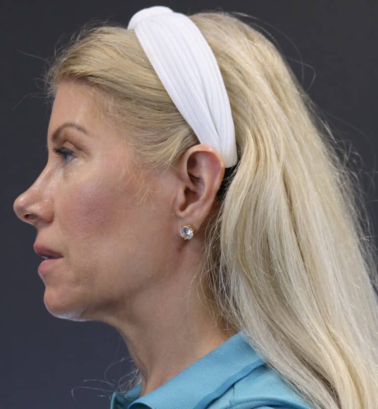 Before Image: Deep Plane Face Lift - left-side