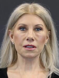 After Image: Deep Plane Face Lift