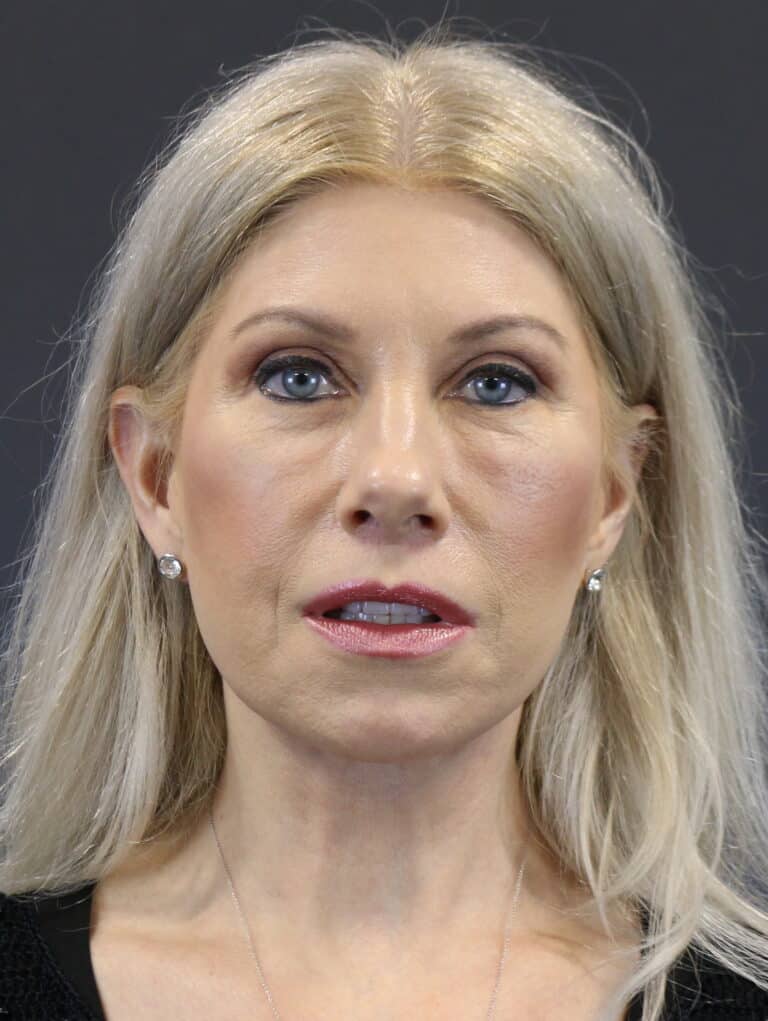After Image: Deep Plane Face Lift - front