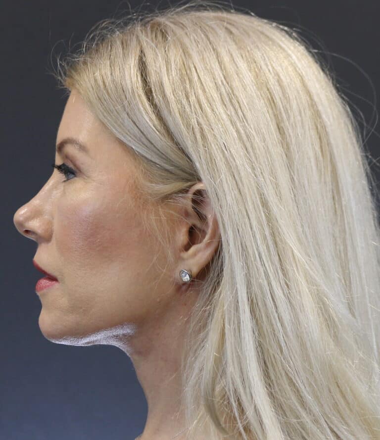After Image: Deep Plane Face Lift - left-side