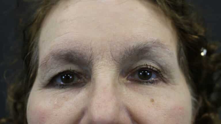 Before Image: Blepharoplasty - front