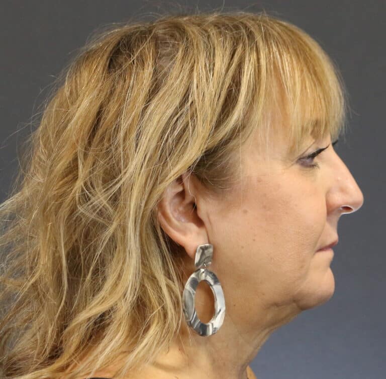 Before Image: Deep Plane Face Lift - front