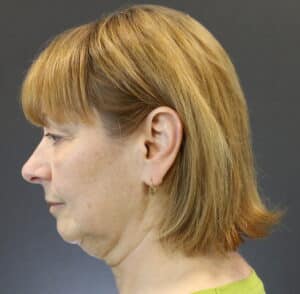 Before Image: Deep Plane Face Lift