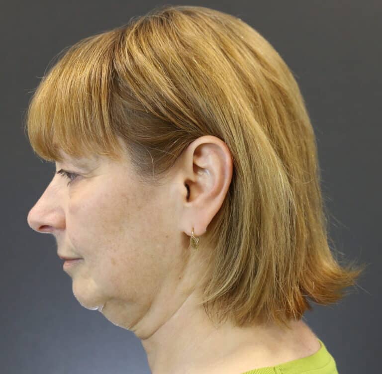 Before Image: Deep Plane Face Lift - left-side