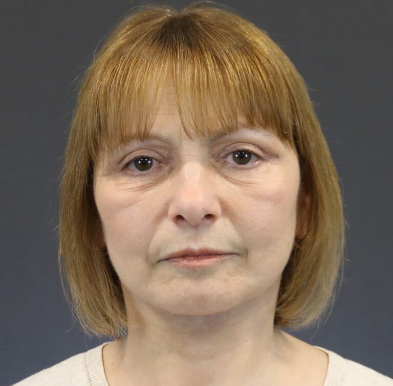 After Image: Deep Plane Face Lift - front