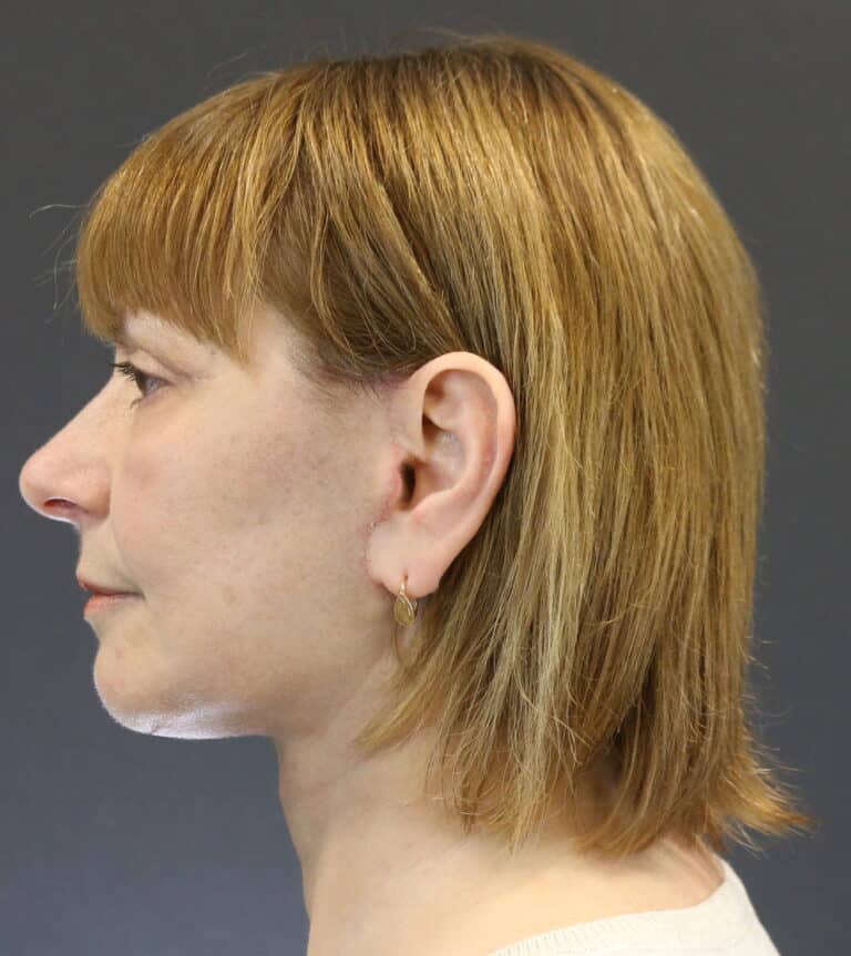 After Image: Deep Plane Face Lift - left-side
