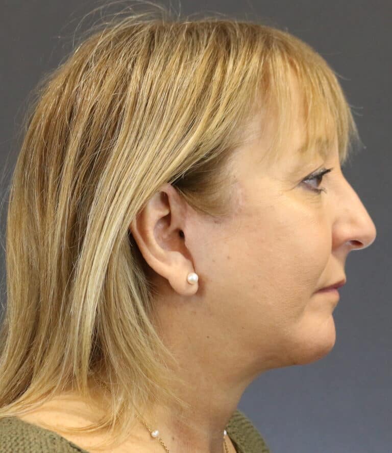 After Image: Deep Plane Face Lift - right-side