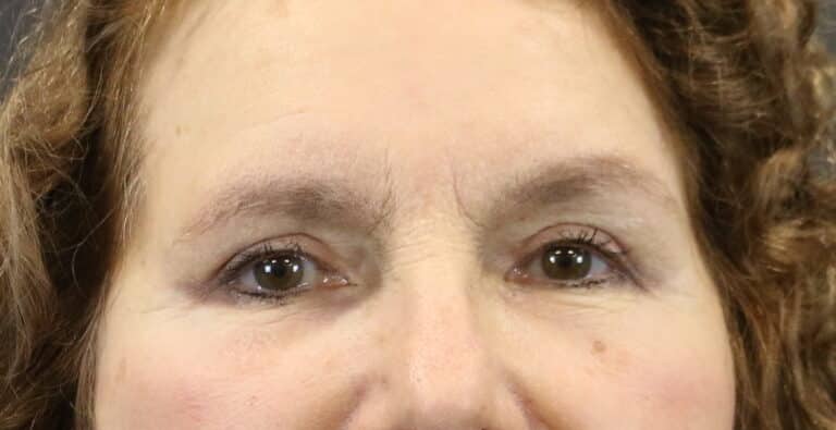 After Image: Blepharoplasty - front