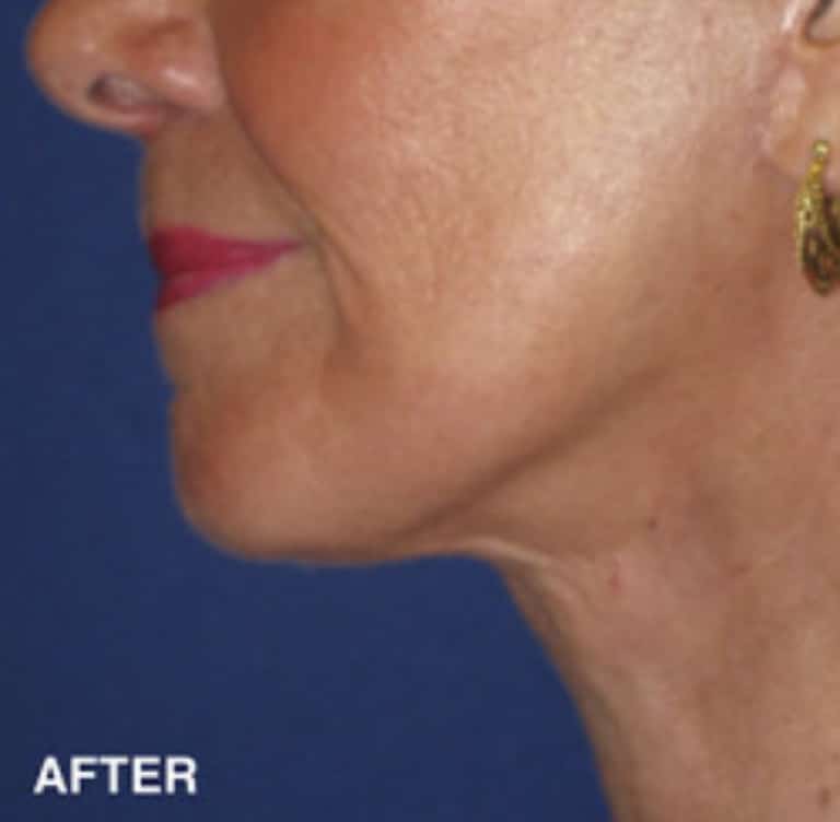 After Image: Neck Lift Patient 15 - other