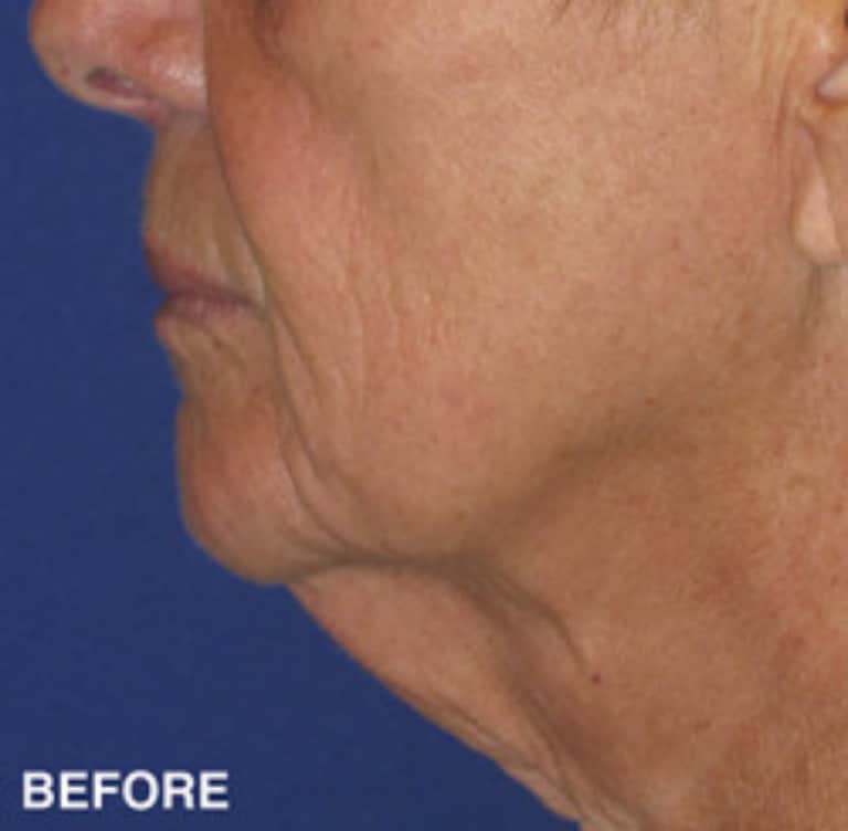 Before Image: Neck Lift Patient 15 - other